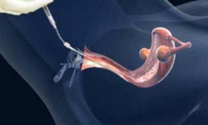 在甘肃省做试管婴儿长方案周期需要多久？超长方案促排流程是怎么样的？